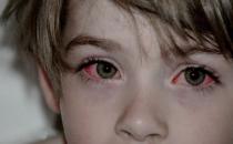 红眼病的传播途径有哪些？