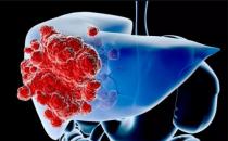 肝癌晚期的症状大揭秘 肝癌晚期手术切除是首选方案
