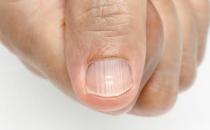 指甲凹陷的日常护理方法 指甲与疾病的预测关系
