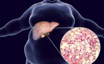 脂肪肝的原因 肥胖和饮酒导致脂肪肝的形成